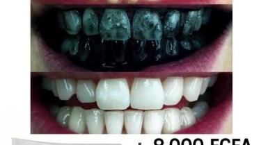 Blanchiment dentaire